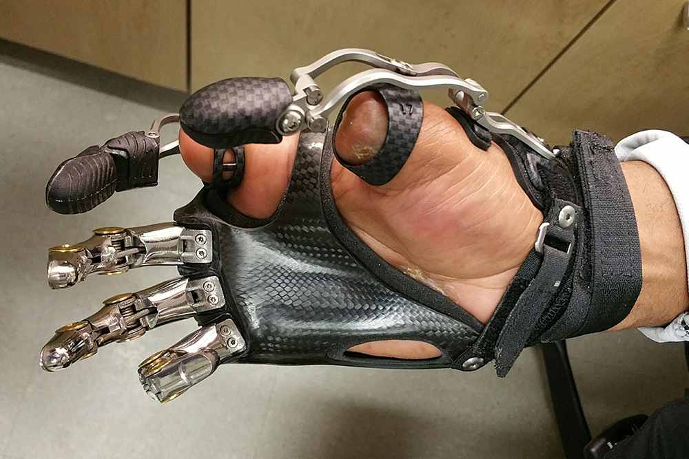 Prosthetic Options Arm Dynamics